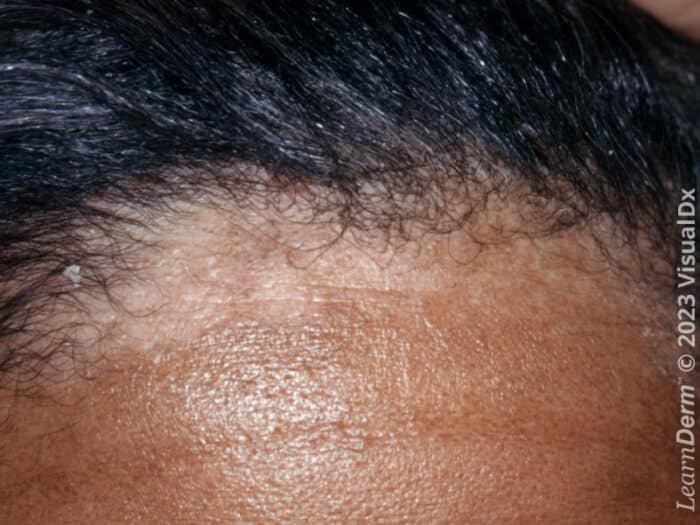 Scalp - LearnDerm